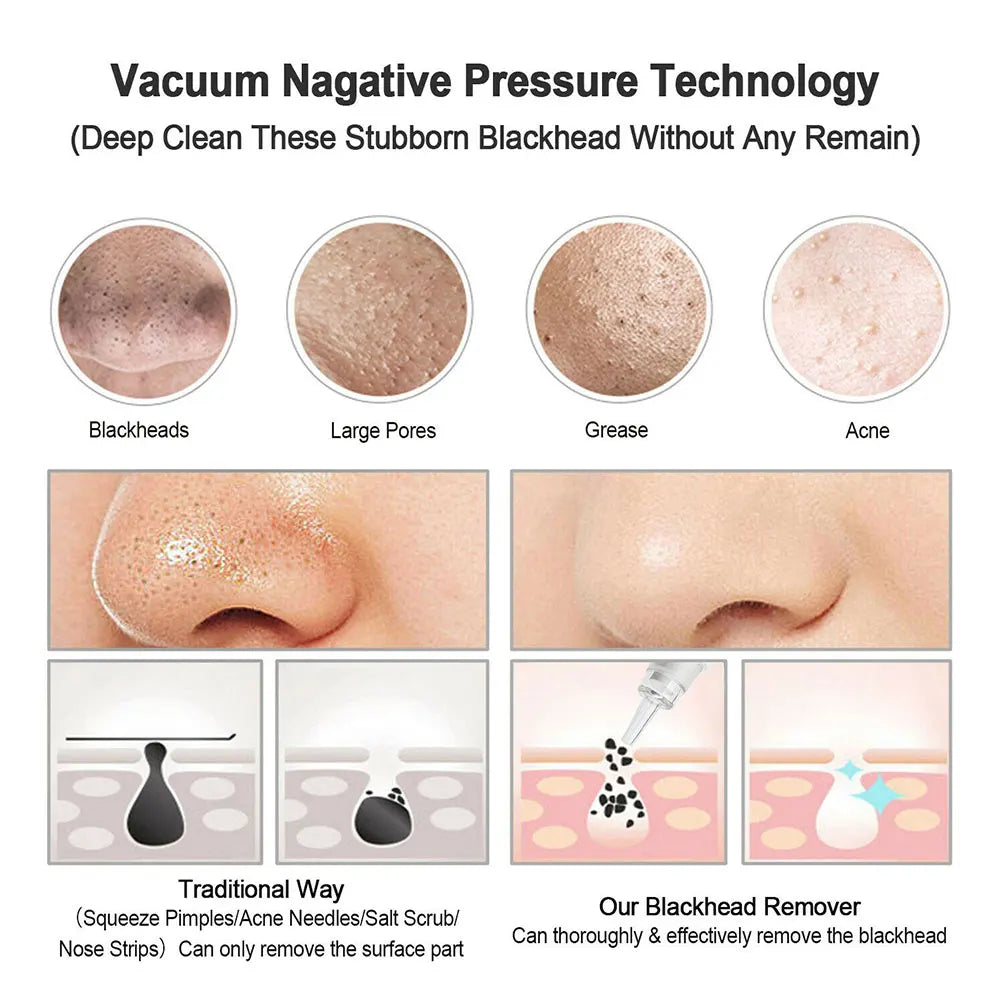 Extracteur de points noirs électrique